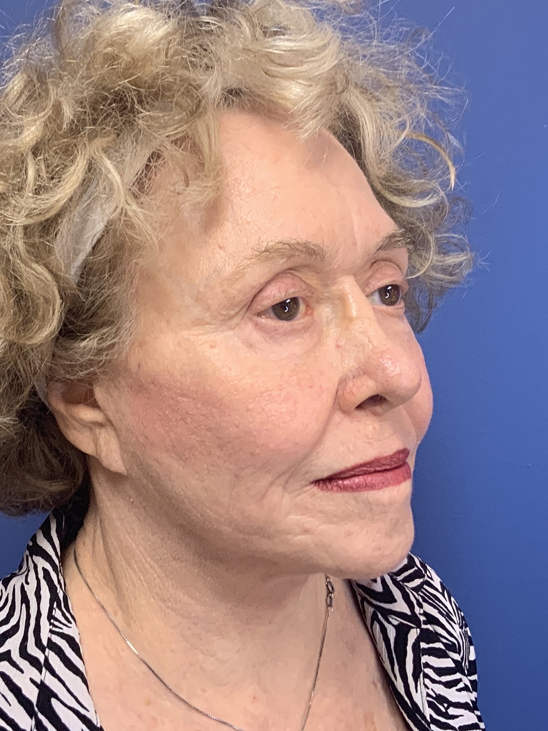 Facelift Before & After