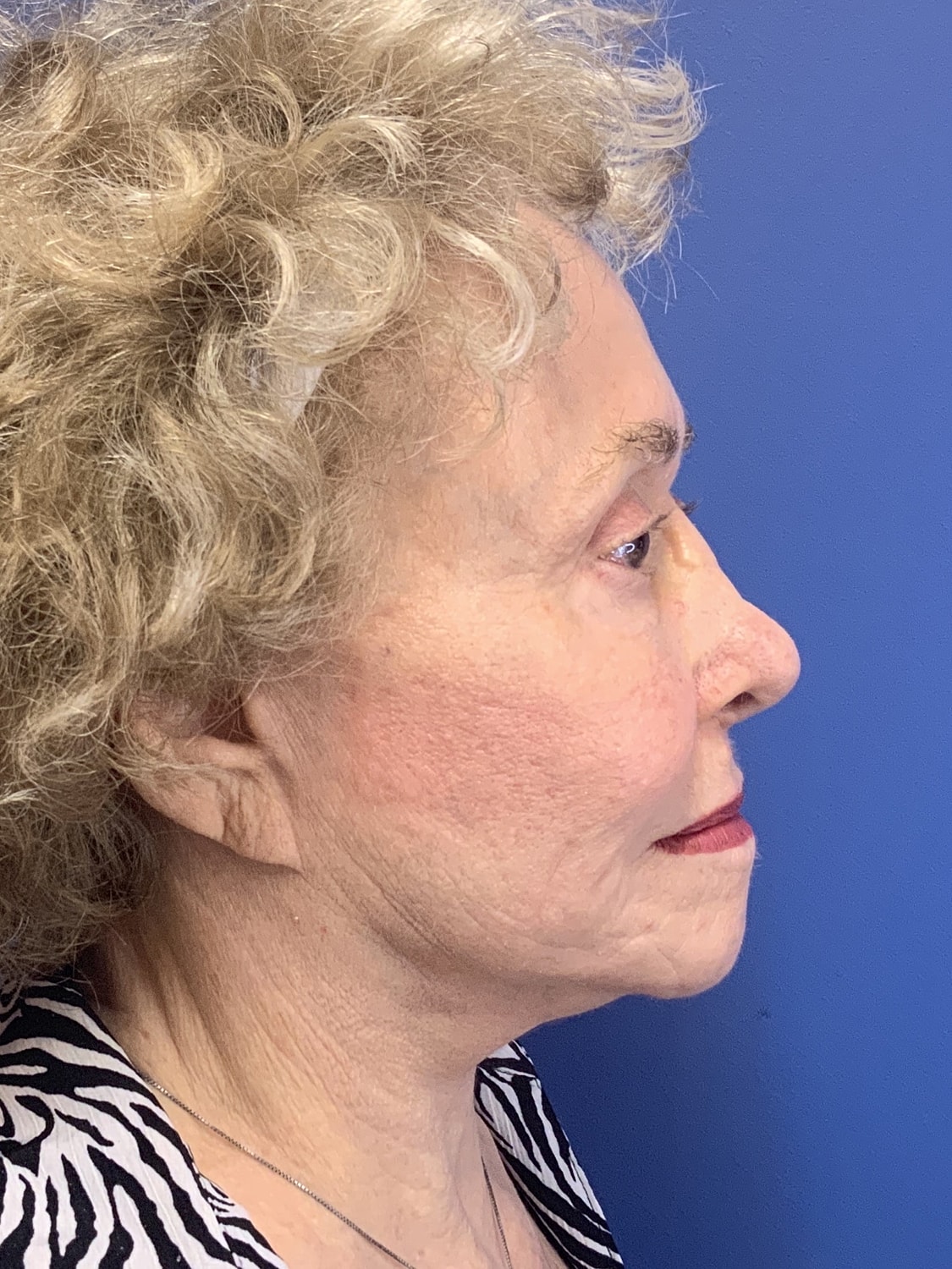 Facelift Before & After
