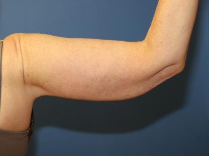 After Weight Loss Surgery Before & After