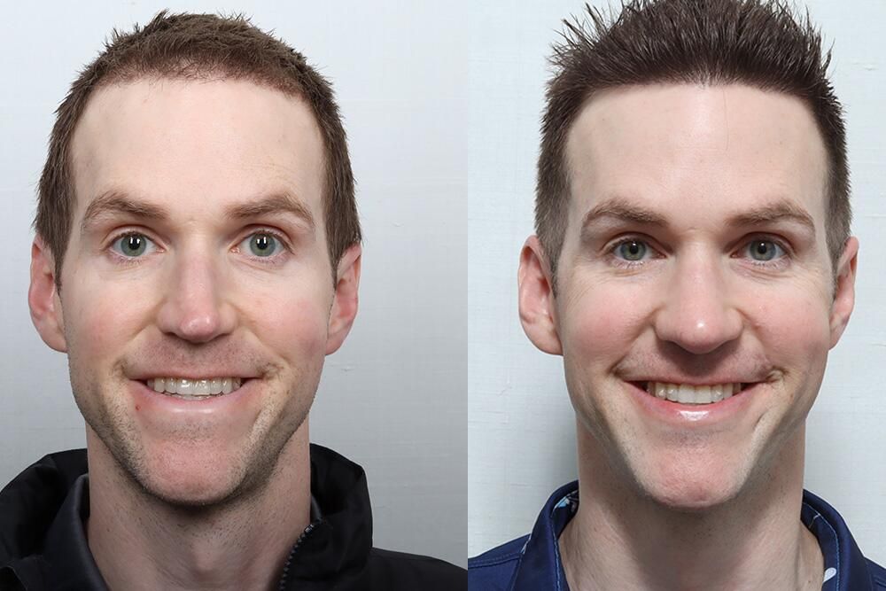 Rhinoplasty Before & After
