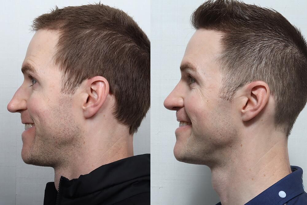 Rhinoplasty Before & After