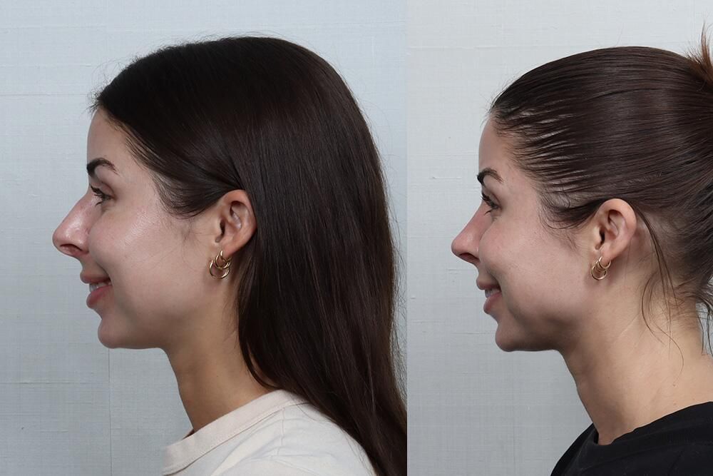 Rhinoplasty Before & After