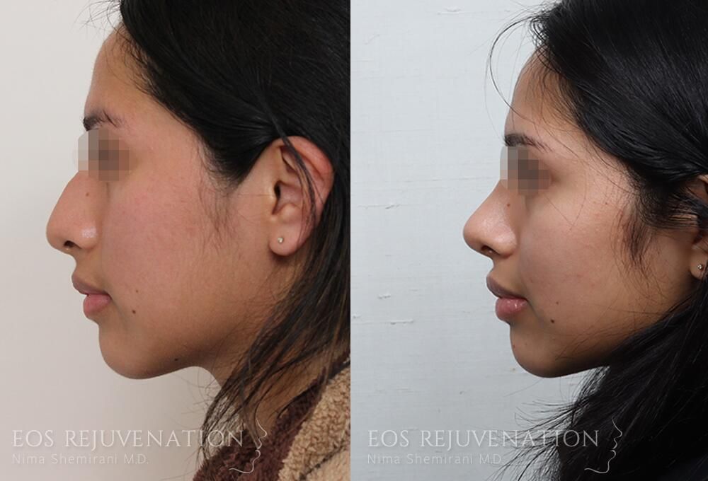 Rhinoplasty Before & After