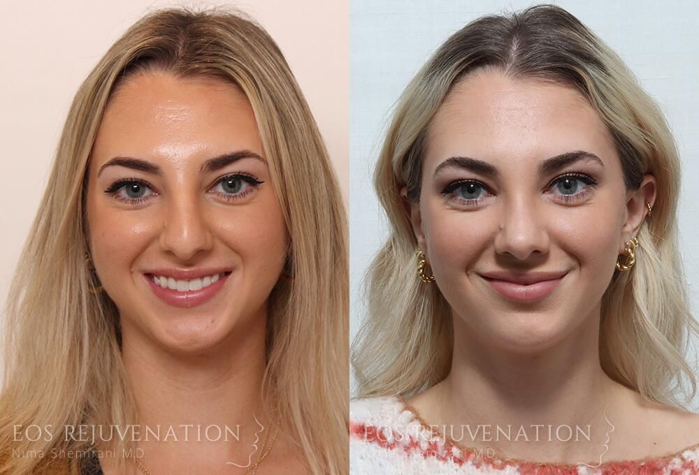 Rhinoplasty Before & After