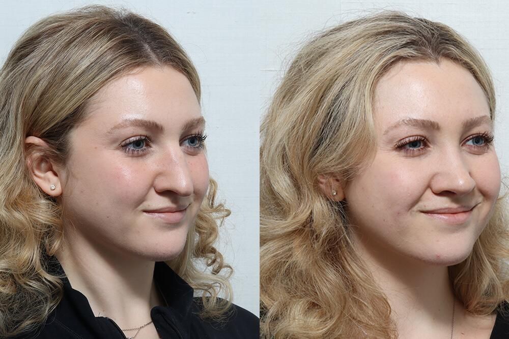 Rhinoplasty Before & After