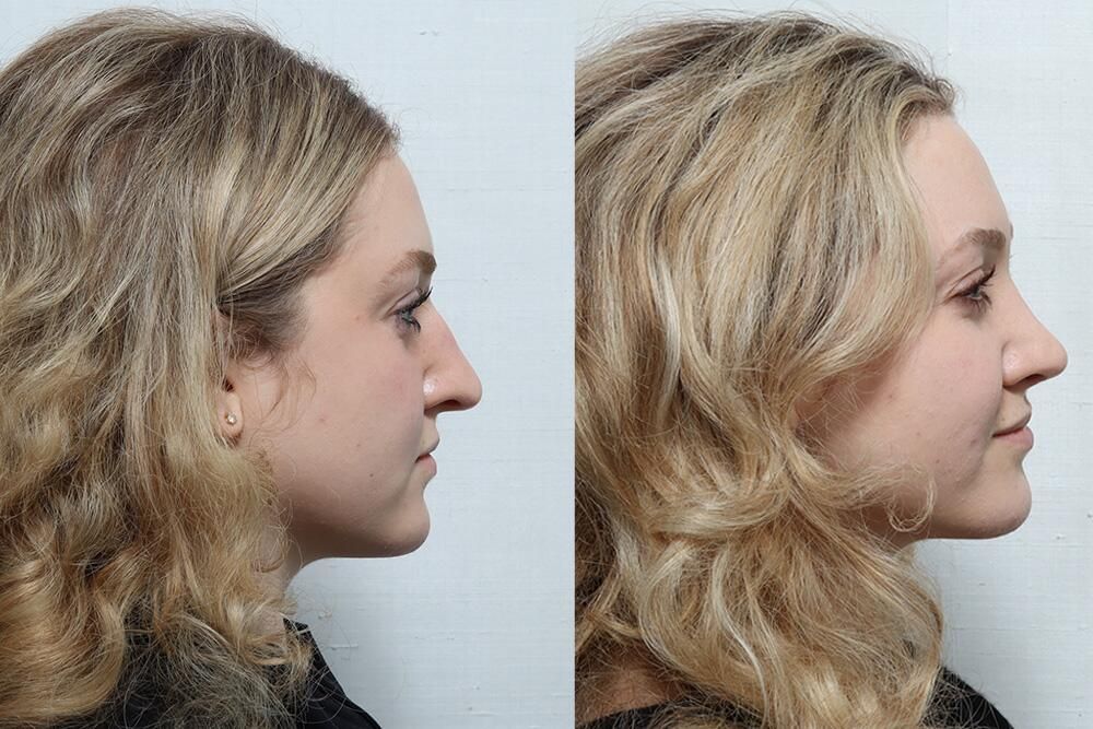 Rhinoplasty Before & After