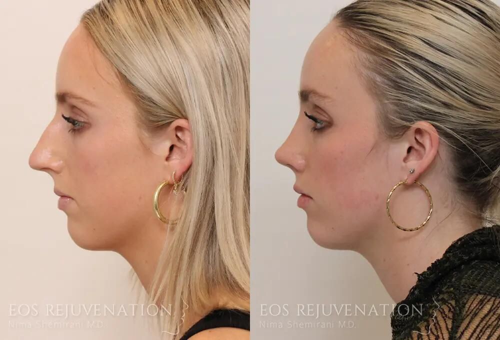 Rhinoplasty Before & After