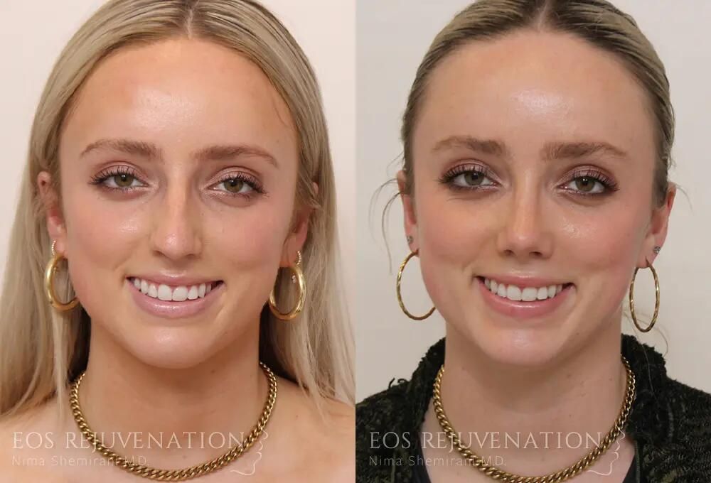 Rhinoplasty Before & After