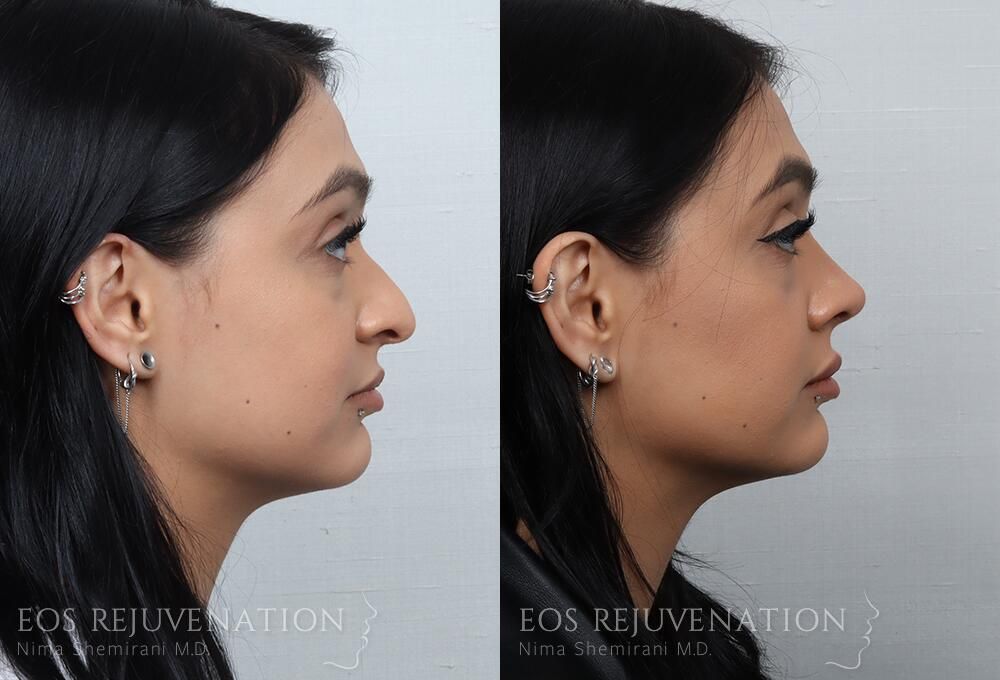Rhinoplasty Before & After