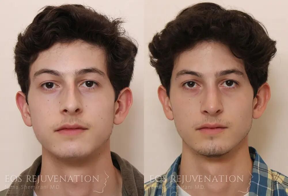 Male Rhinoplasty Before & After
