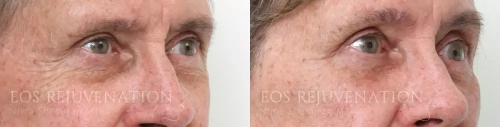 Lower Blepharoplasty Before & After