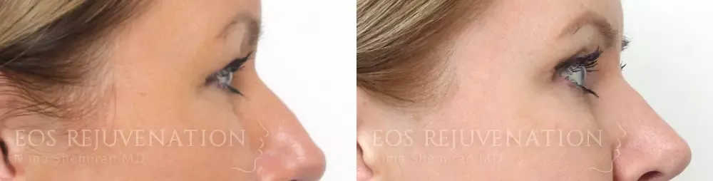 Upper Blepharoplasty Before & After