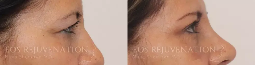 Blepharoplasty Before & After