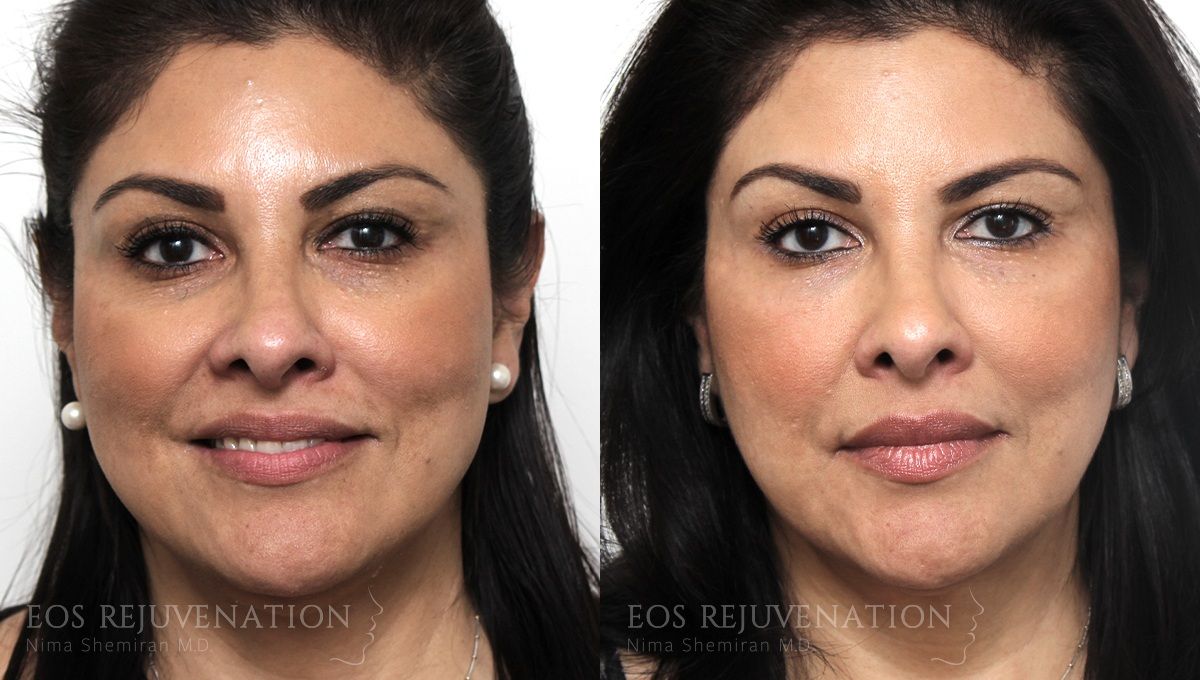 Liquid Facelift Before & After