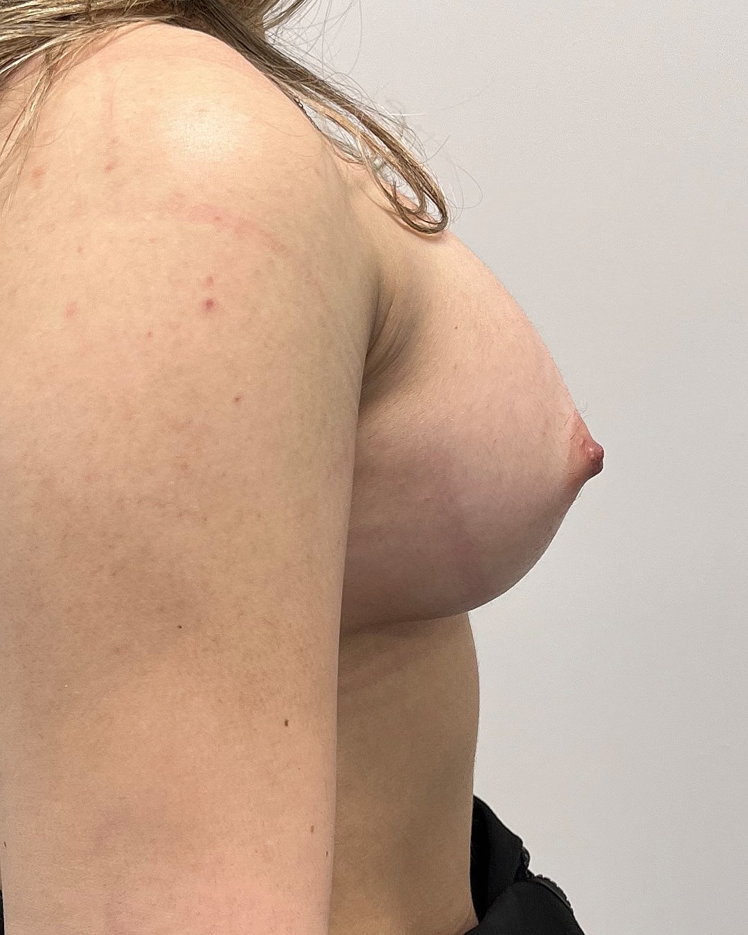 Breast Augmentation Before & After