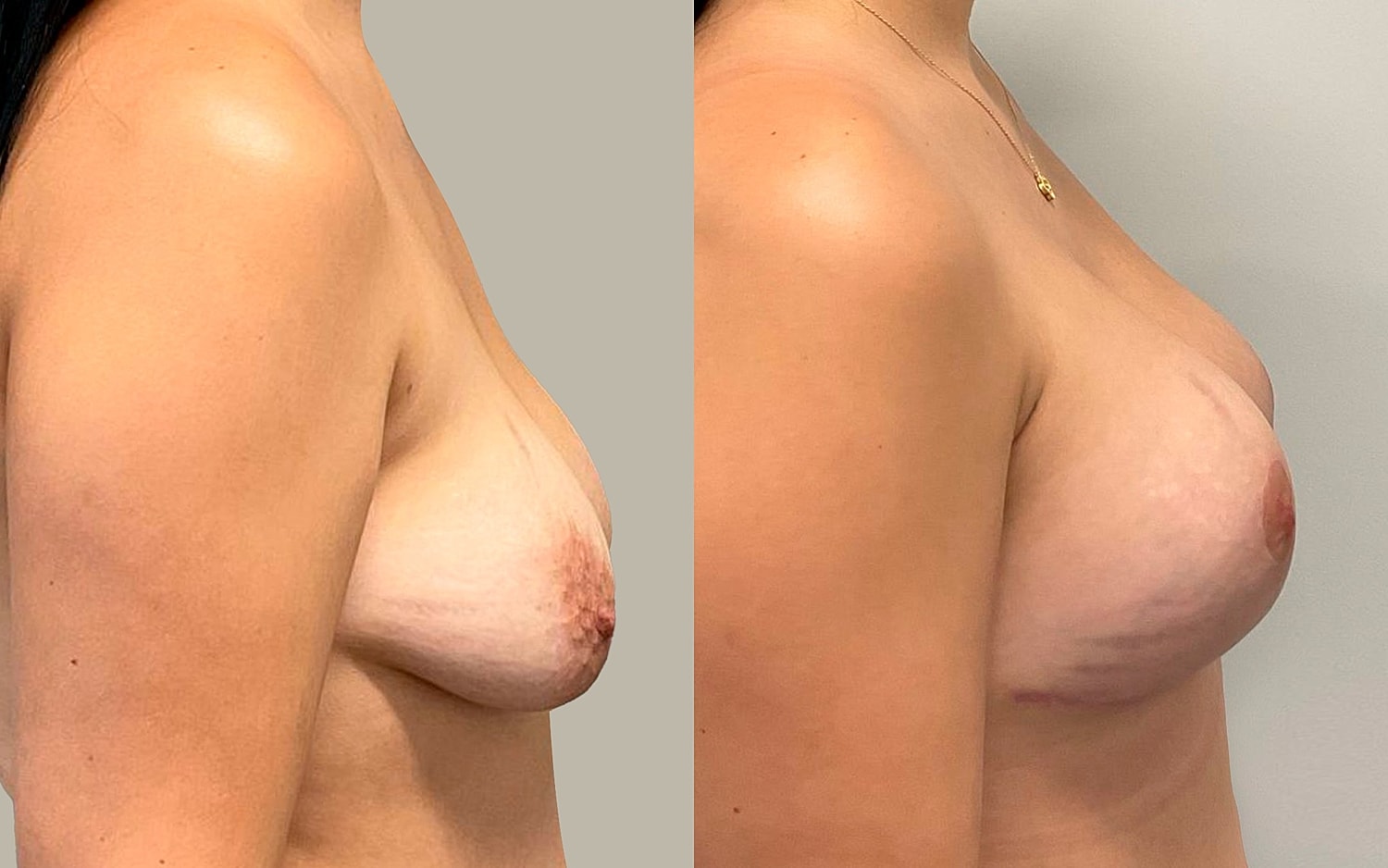 Breast Lift Before & After