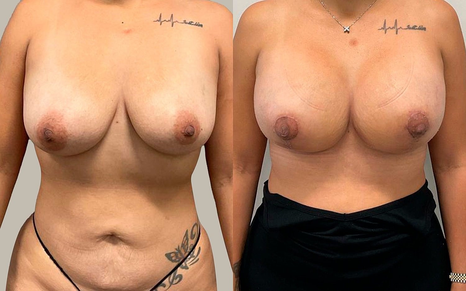 Breast Lift Before & After