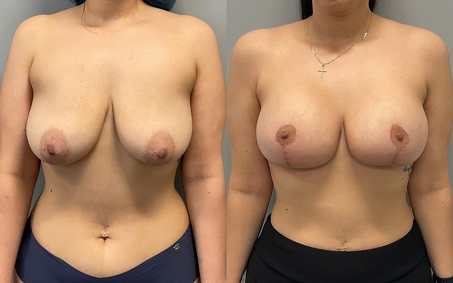 Breast Lift Before & After