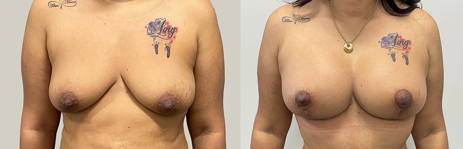 Breast Lift Before & After