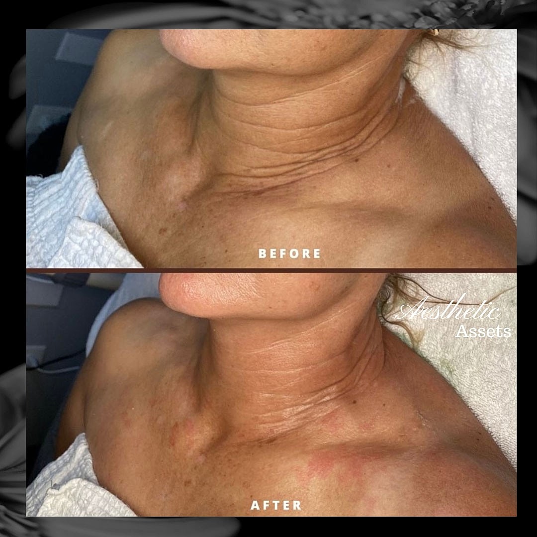 3D Enzyme Therapy Treatment at Aesthetic Assets - Image 4