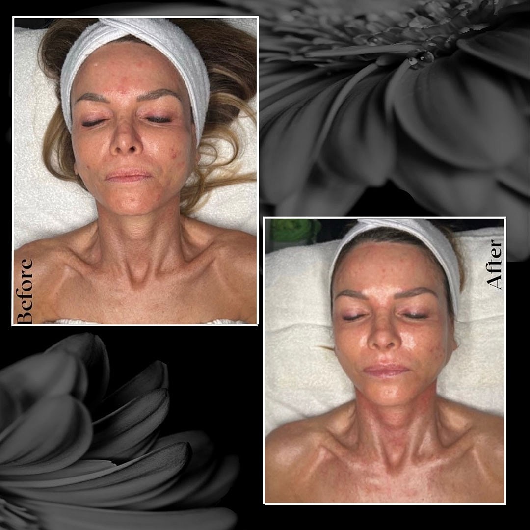 3D Enzyme Therapy Treatment at Aesthetic Assets - Image 3