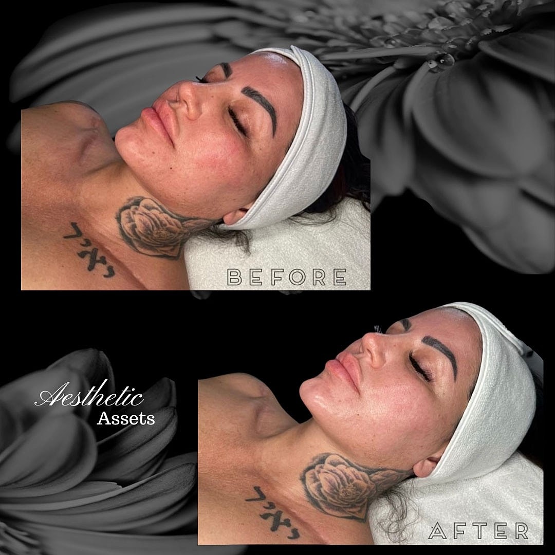 3D Enzyme Therapy Treatment at Aesthetic Assets - Image 2