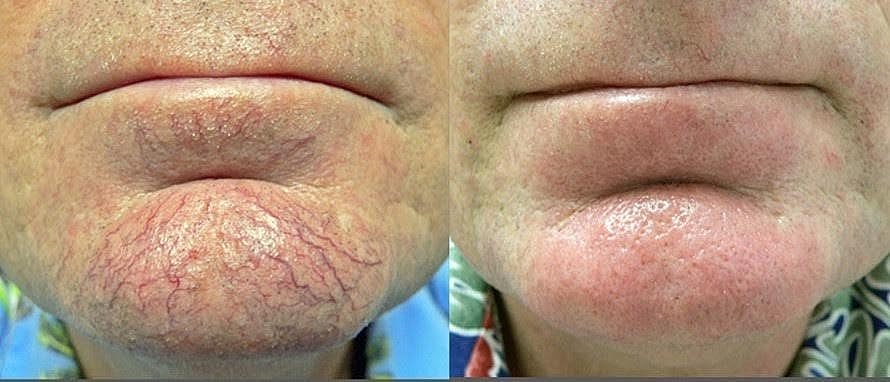 5 Reasons to Try an IPL Photofacial