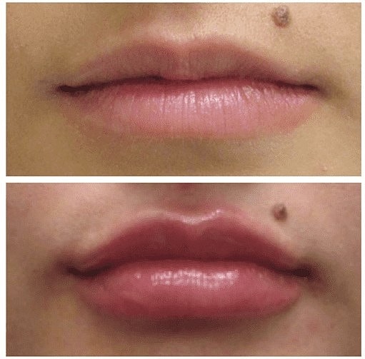 5 Reasons Why Dermal Fillers Like Juvéderm® and Restylane® Are So Popular - Image 2