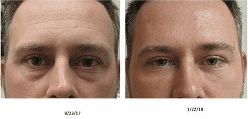 5 Reasons Why Dermal Fillers Like Juvéderm® and Restylane® Are So Popular - Image 3