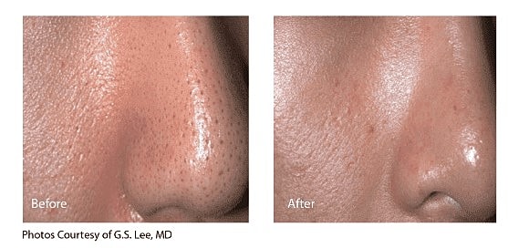 A Hollywood Laser Peel Isn’t Just for Celebrities - Image 3