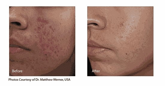 A Hollywood Laser Peel Isn’t Just for Celebrities - Image 4