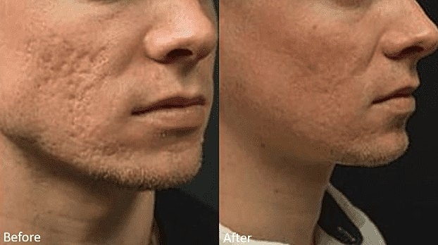 Achieve a Youthful Complexion With the Lutronic Genius™ - Image 3