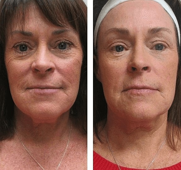 Achieve a Youthful Complexion With the Lutronic Genius™ - Image 4