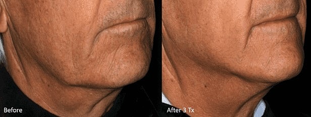 Achieve a Youthful Complexion With the Lutronic Genius™ - Image 5