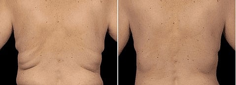 Body Sculpting: The Cool Way with CoolSculpting - Image 3