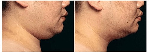 Body Sculpting: The Cool Way with CoolSculpting - Image 2