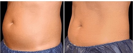 Body Sculpting: The Cool Way with CoolSculpting - Image 4