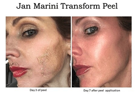 Choosing the Right Chemical Peel for You - Image 2