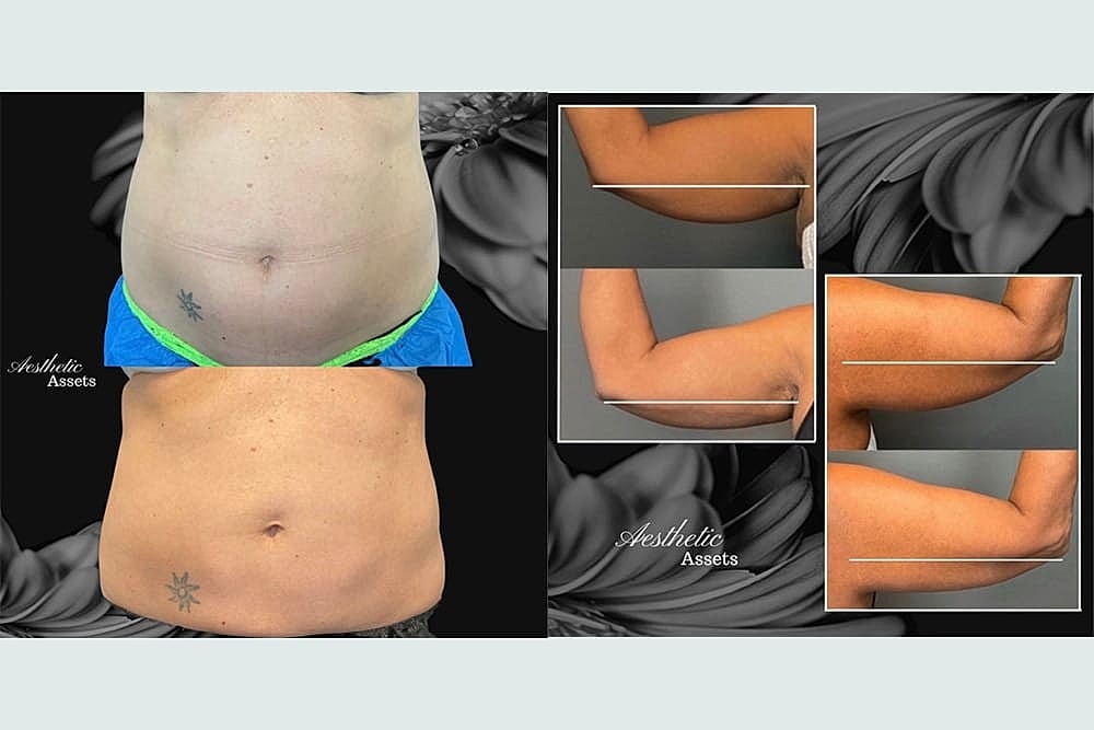 Contours Redefined: The Fusion of CoolSculpting Elite & Accufit for Ultimate Body Transformation - Image 2