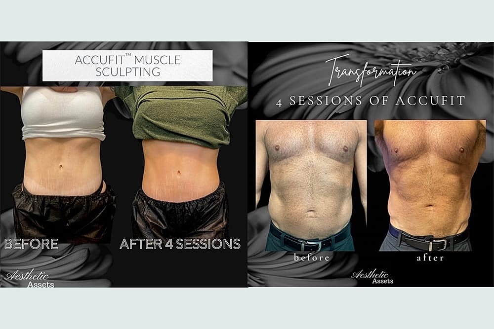 Contours Redefined: The Fusion of CoolSculpting Elite & Accufit for Ultimate Body Transformation - Image 3