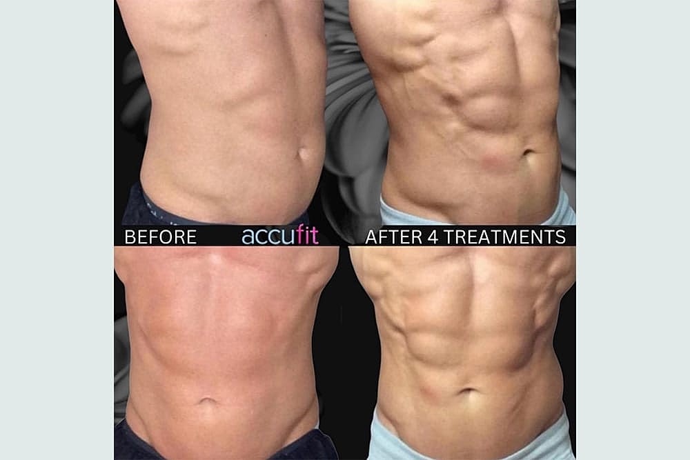 Contours Redefined: The Fusion of CoolSculpting Elite & Accufit for Ultimate Body Transformation