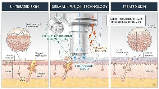 DermalInfusion: The All in One Solution for Better Looking Skin - Image 2