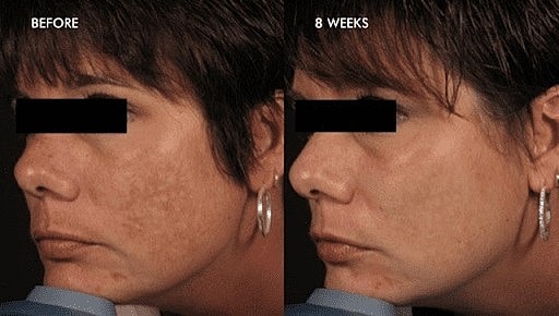 DermalInfusion: The All in One Solution for Better Looking Skin - Image 3