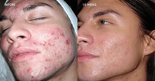 DermalInfusion: The All in One Solution for Better Looking Skin - Image 4