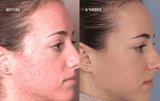 DermalInfusion: The All in One Solution for Better Looking Skin - Image 5