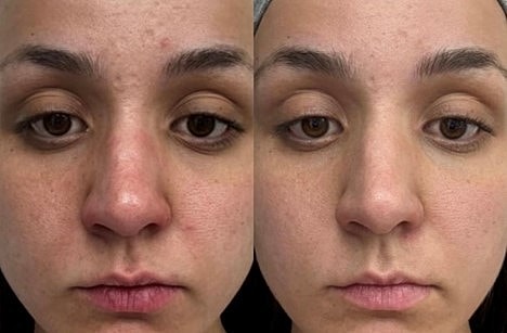 Discover the Best Skin Resurfacing Treatments in Scottsdale! - Image 2