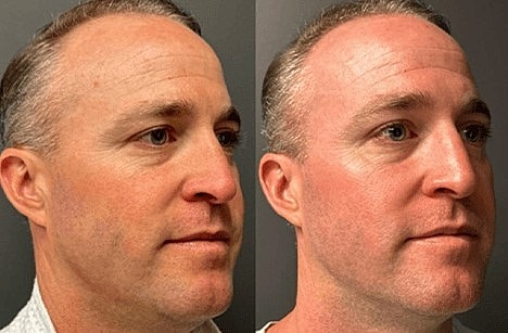 Discover the Best Skin Resurfacing Treatments in Scottsdale! - Image 4