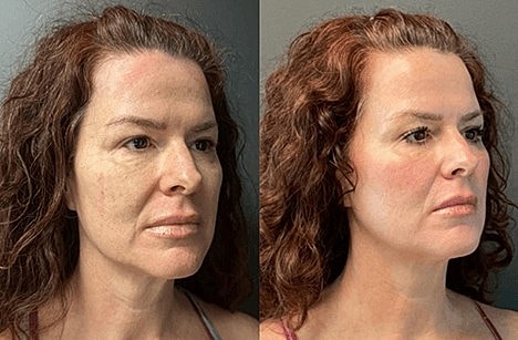 Discover the Best Skin Resurfacing Treatments in Scottsdale! - Image 9