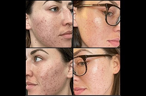 Discover the Best Skin Resurfacing Treatments in Scottsdale! - Image 11