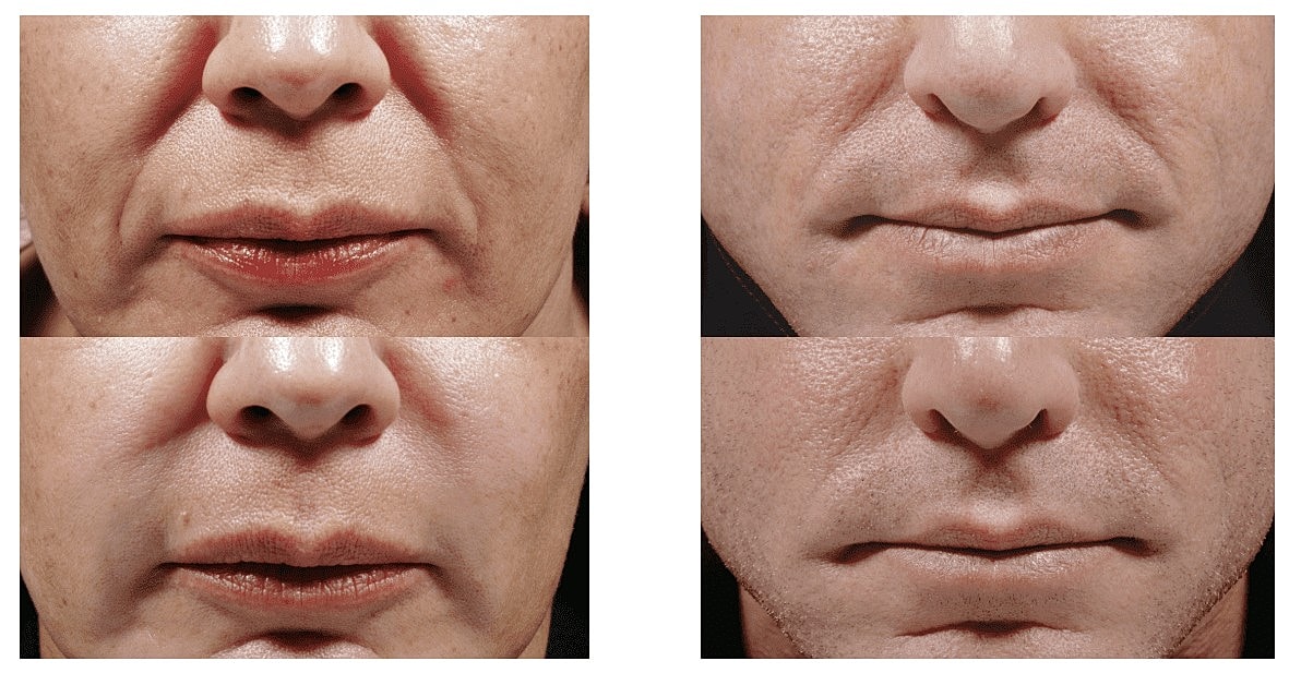 Discover Why Everyone Is Raving About Bellafill, the Dermal Filler With Results That Last 5 Years - Image 2